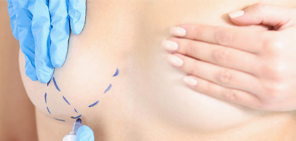 Breast Reduction Surgery