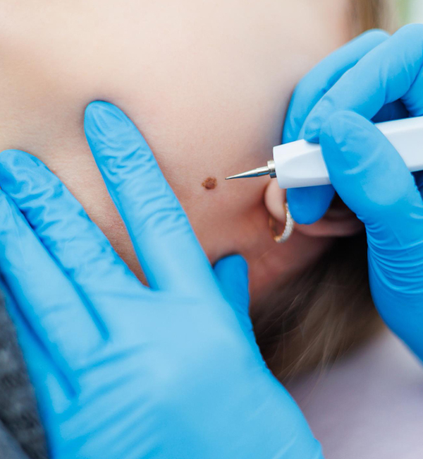 Mole removal treatment at WFY Plastic Surgery