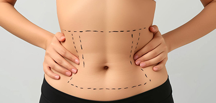 Tummy Tuck Surgery