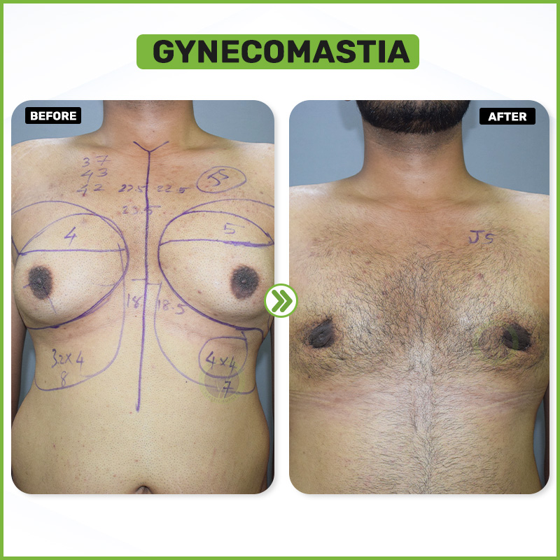 Before After Result 6