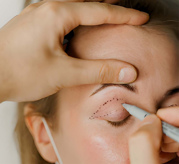 Blepharoplasty surgery consultation and treatment planning