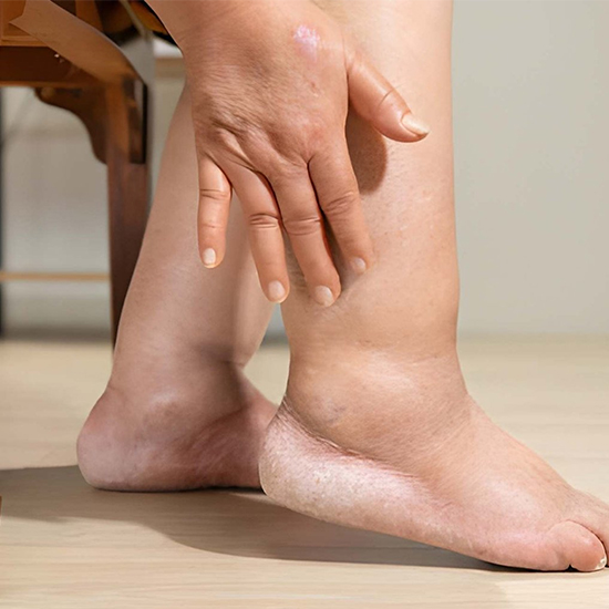 Diabetic Foot Surgery Clinic in Gurgaon at WFY Plastic Surgery