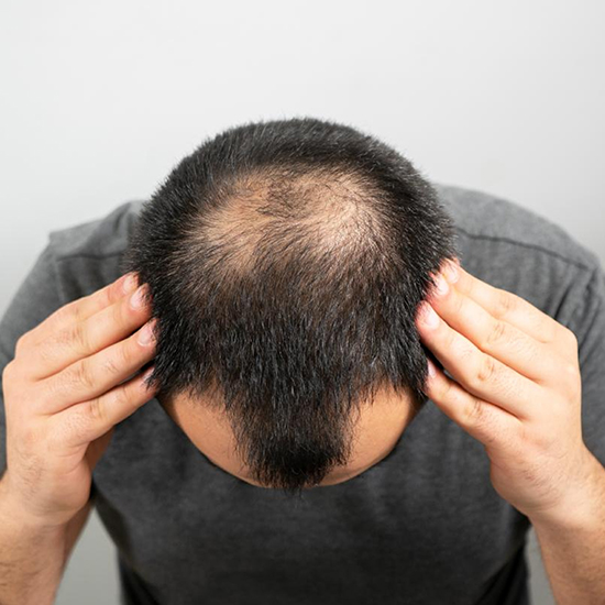 FUE Hair Transplant Clinic in Gurgaon at WFY Plastic Surgery
