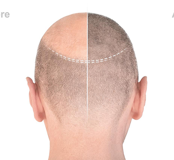 FUE Hair Transplant treatment at WFY Plastic Surgery