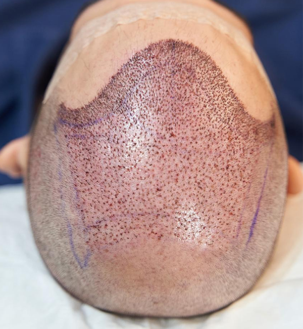 FUT hair transplant risks and treatment planning