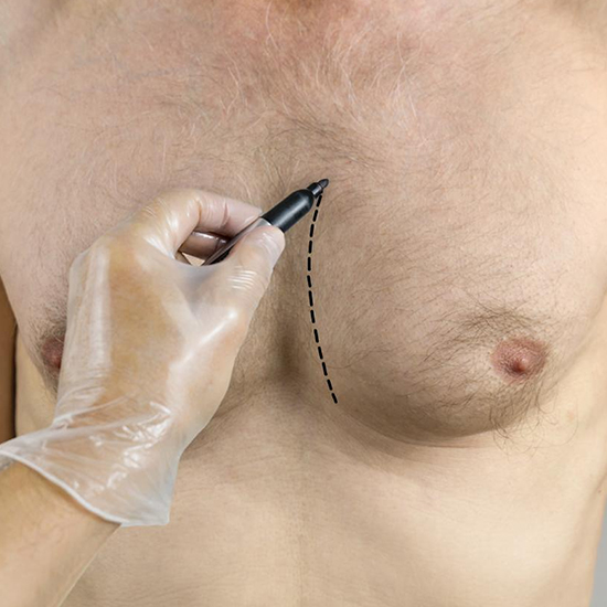 Gynecomastia treatment at WFY Plastic Surgery
