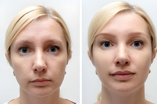 Lip Lift Surgery in Gurgaon