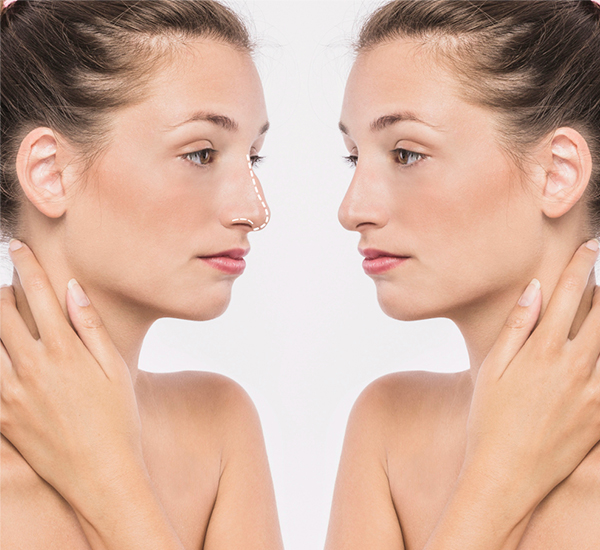 Rhinoplasty Surgery treatment at WFY Plastic Surgery