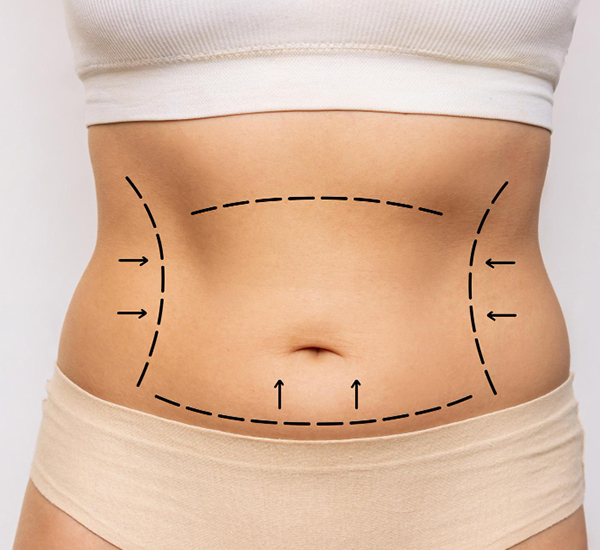 Tummy tuck surgery consultation and treatment planning