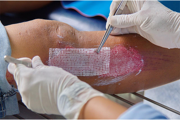 Wound Care in Gurgaon