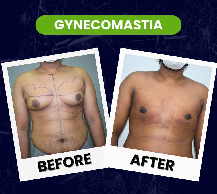 gynicomastia plastic surgery
