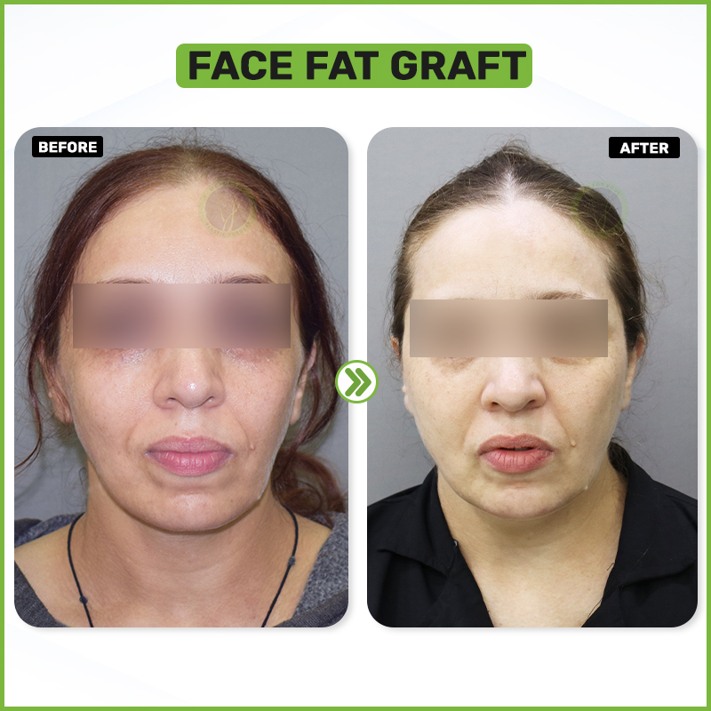 Face Grafting