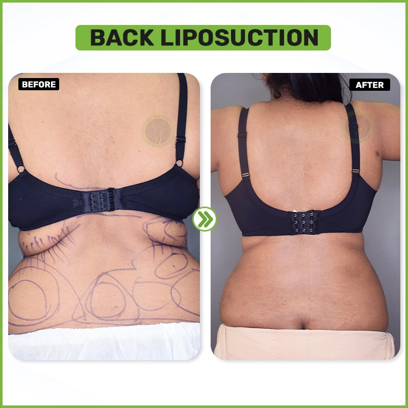 Back Liposuctiopn