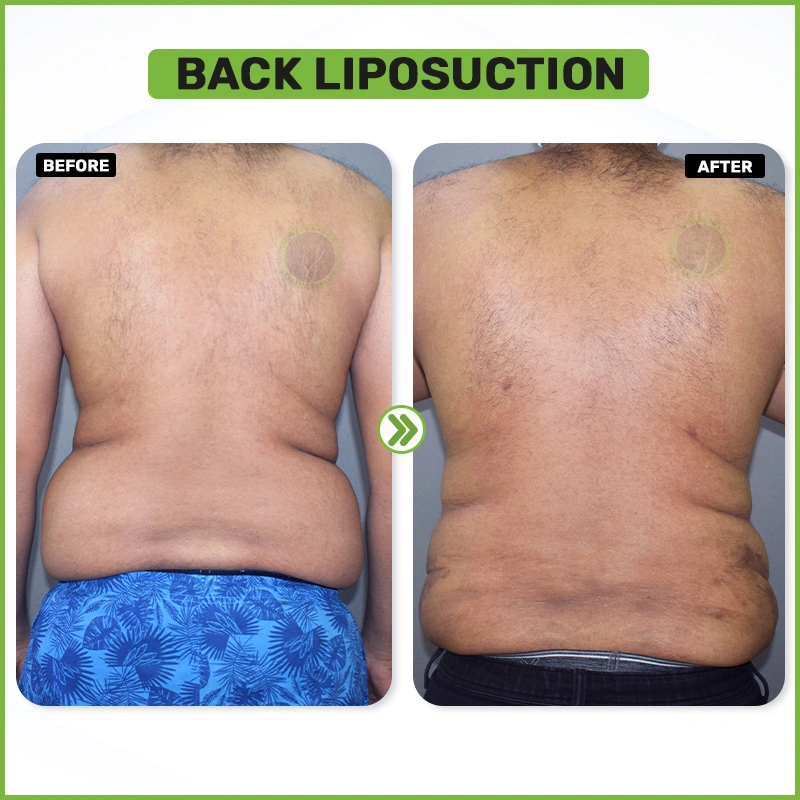 Liposuction