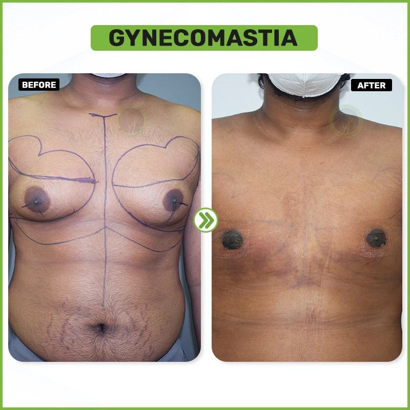 Gynecomastia 