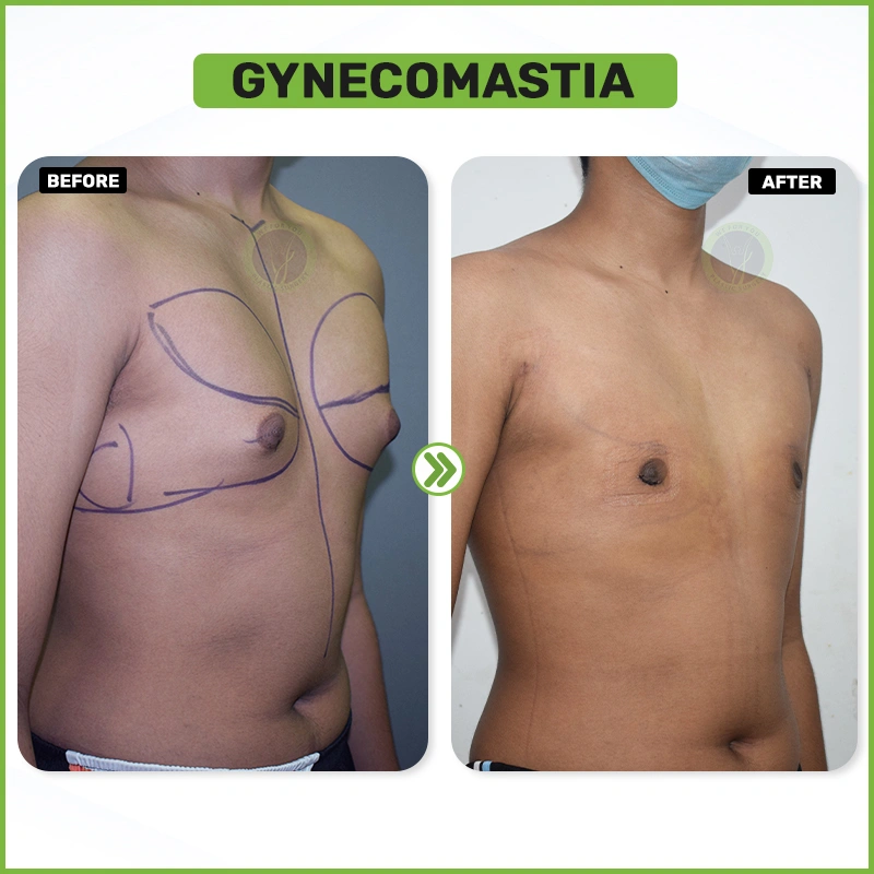 Gynecomastia
