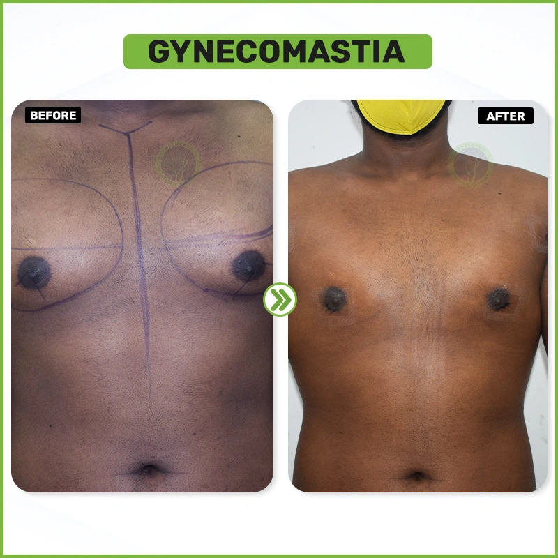 Gynecomastia