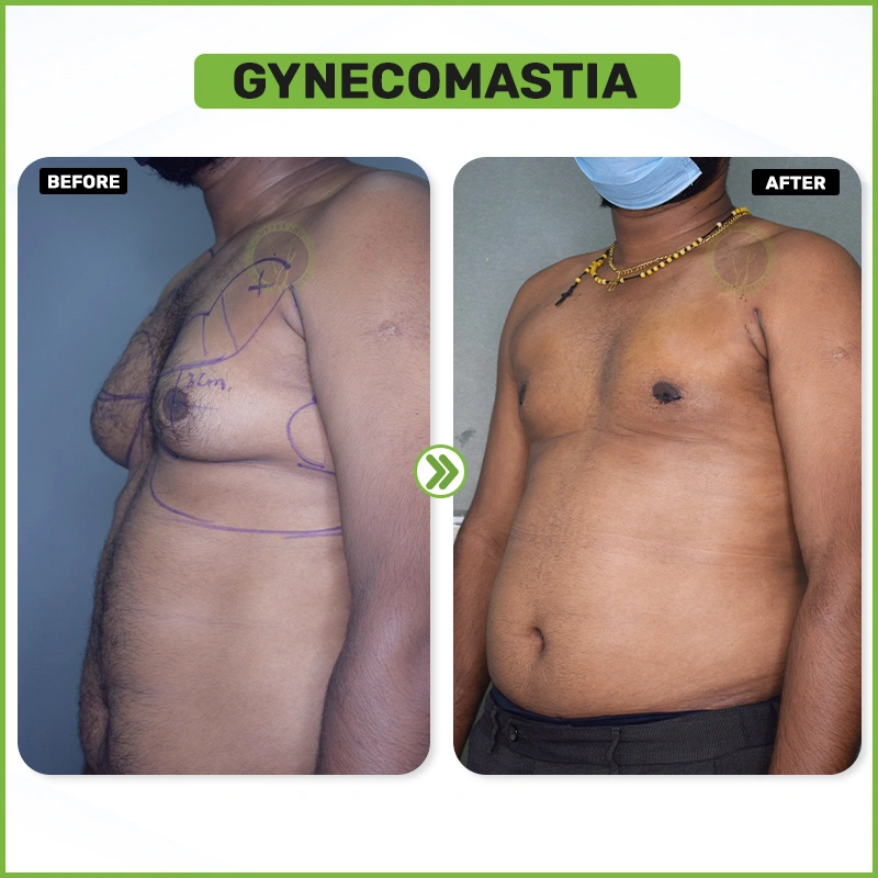 Gynecomastia