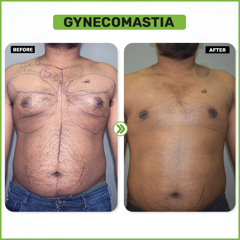 Gynecomastia before and after
