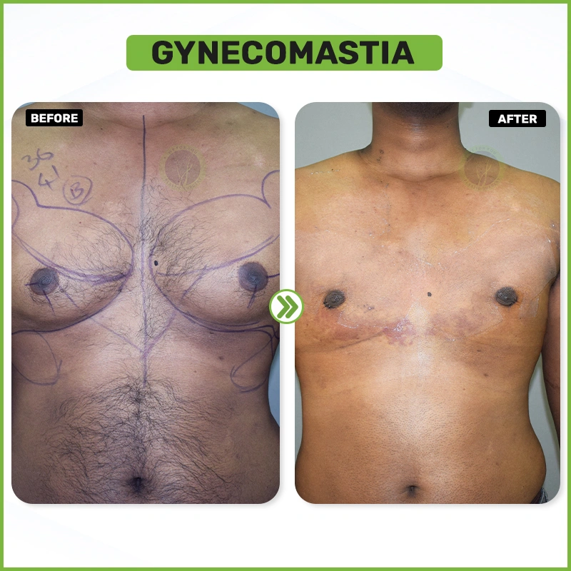Gynecomastia Before & After