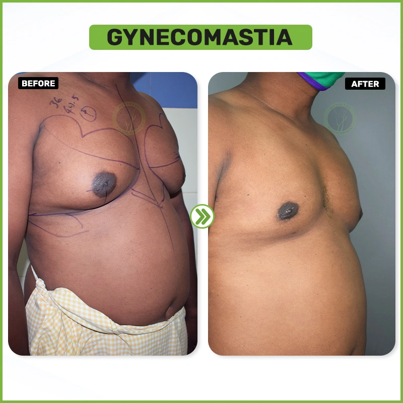 Gynecomastia B&A