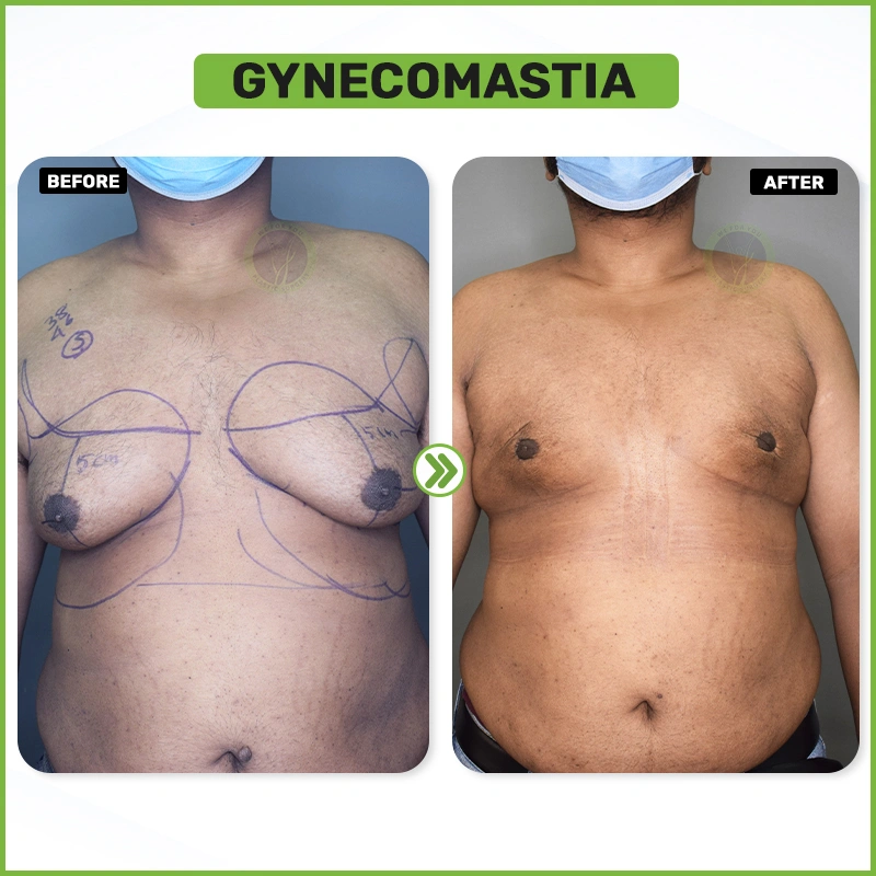 Gynecomastia Before and after