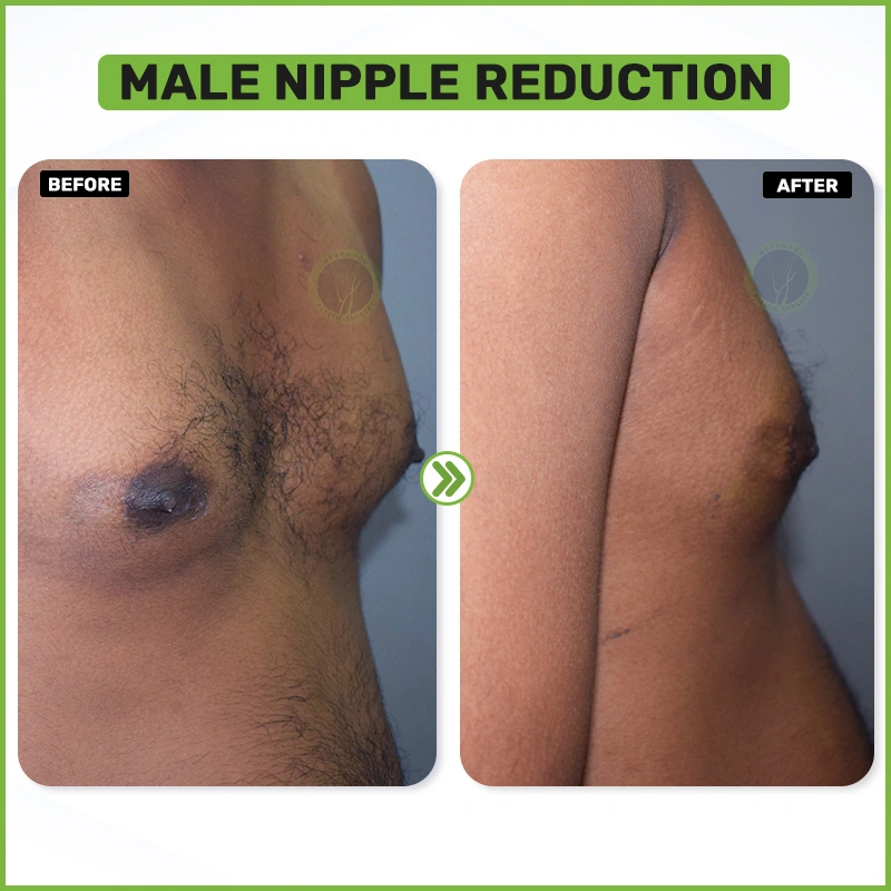Male Nipple reduction 