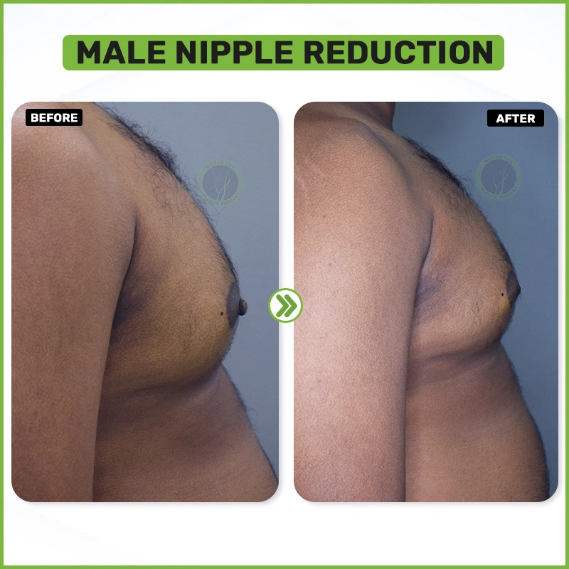 Male Nipple Reduction Before and after