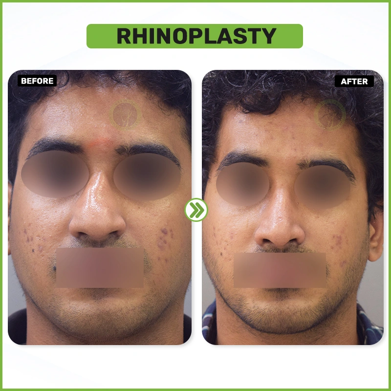 rhinoplasty Before and after