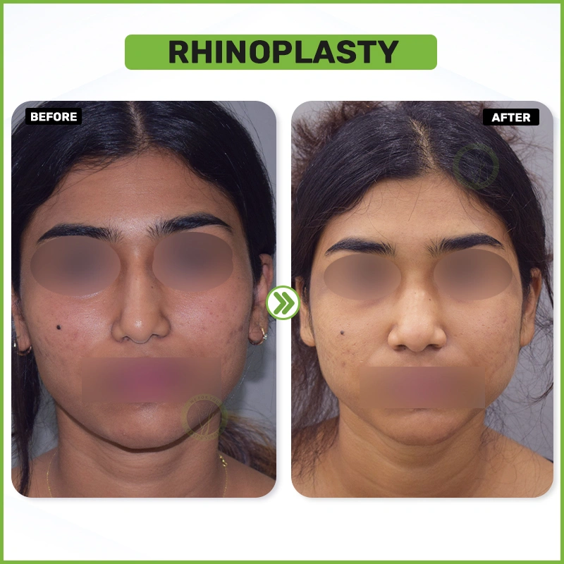 rhinoplasty B&A