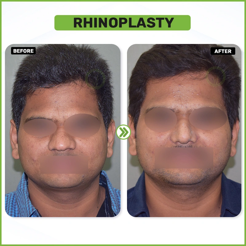 rhinoplasty Before and after