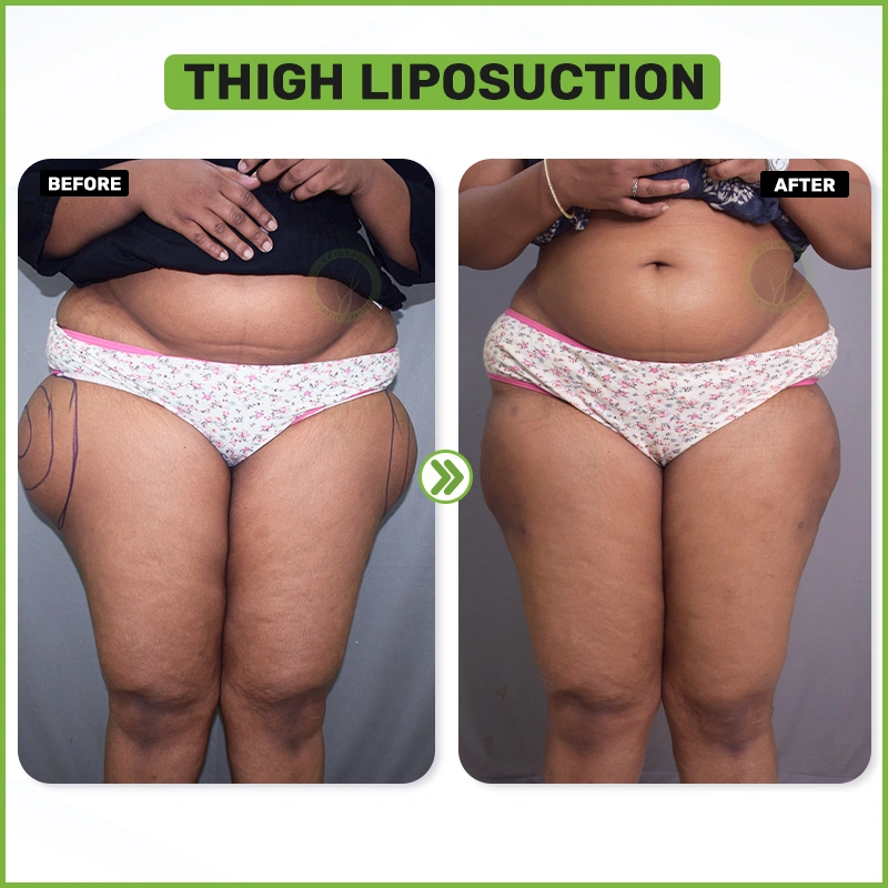 Thigh liposuction before and after