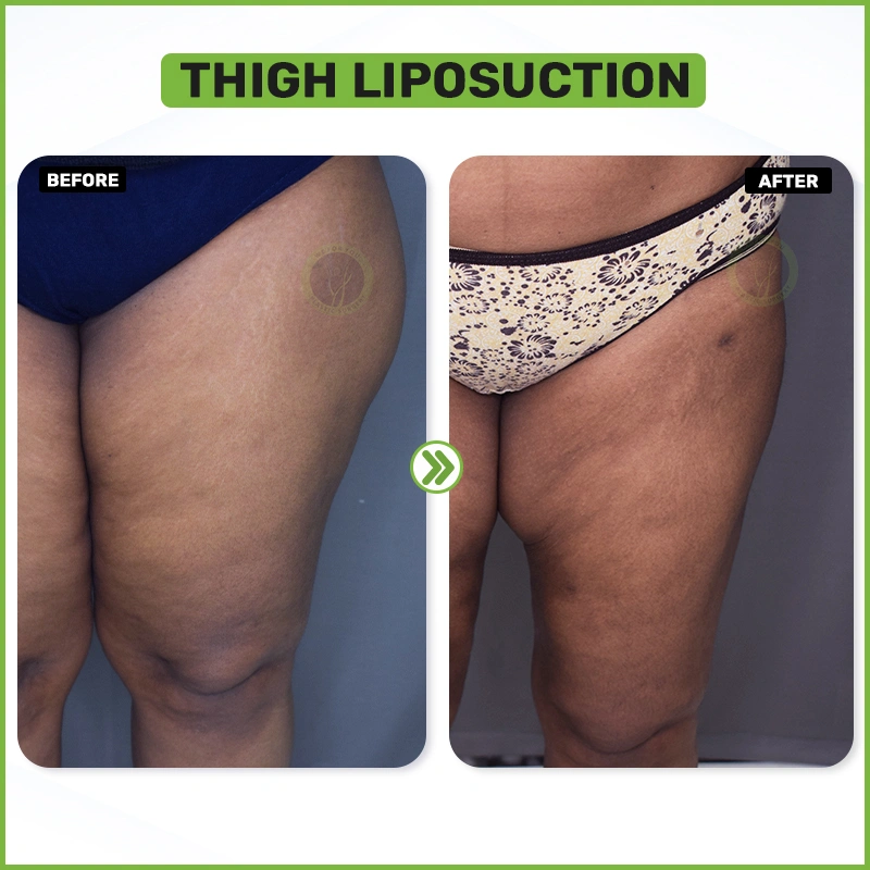 Thigh liposuction before and after 
