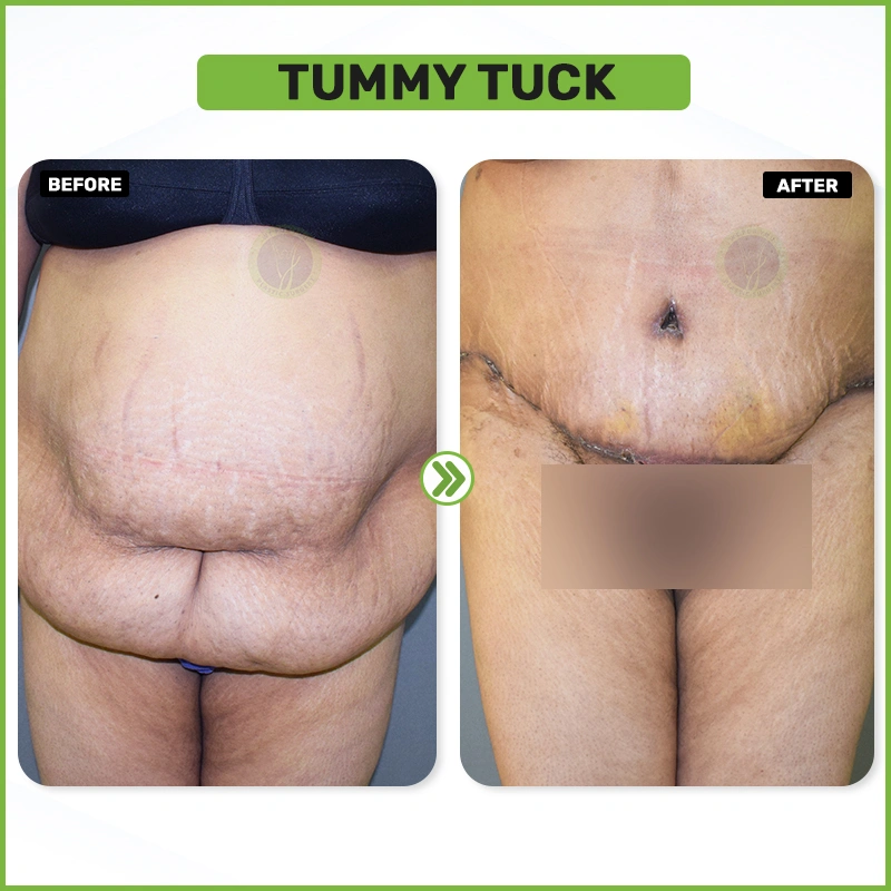Tummy tuck Before and after