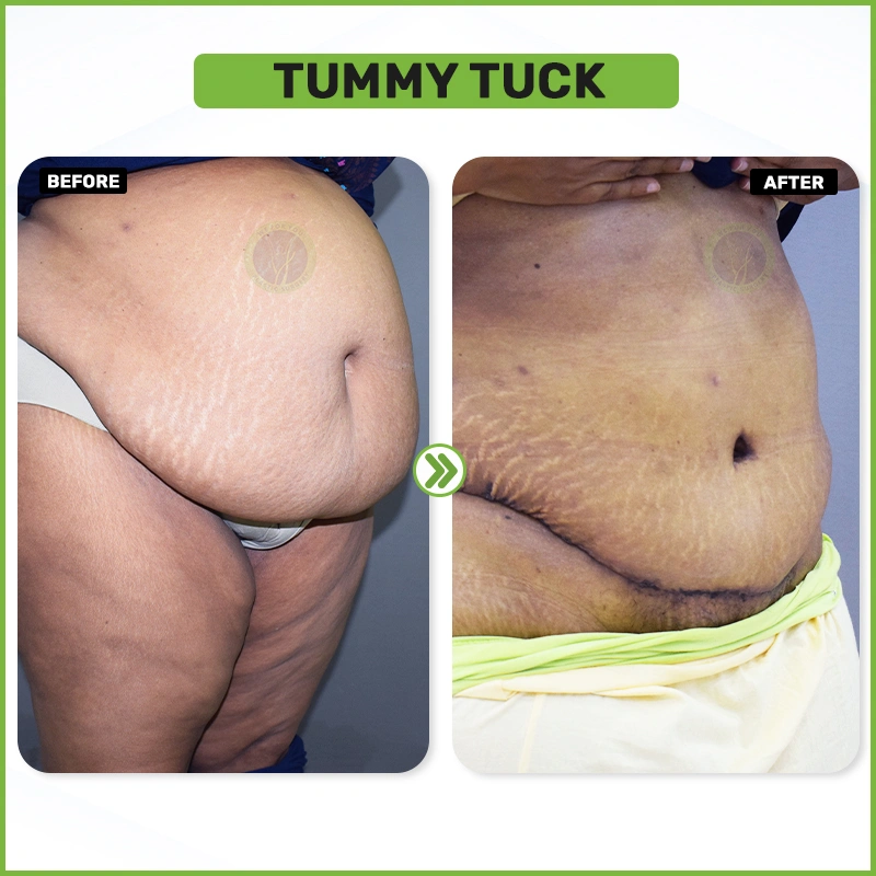 Tummy tuck Before and after