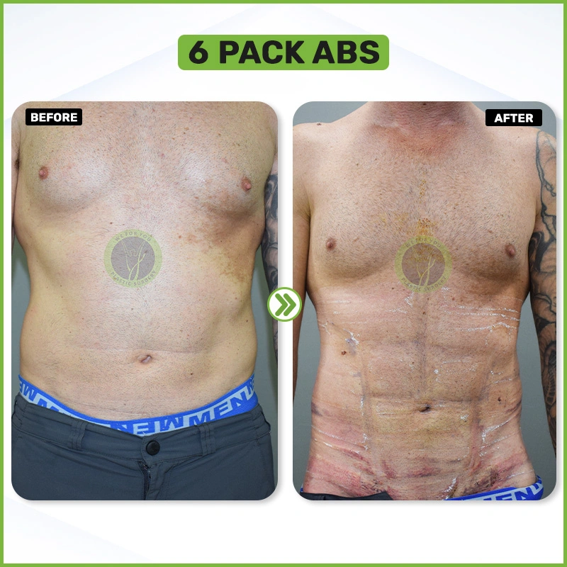 6 pack abs before and after
