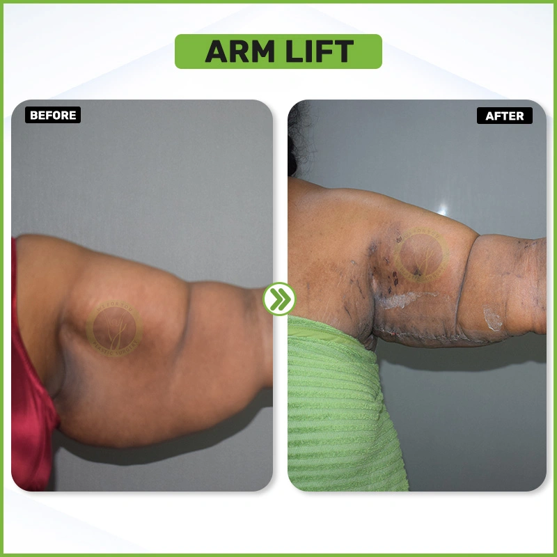 ARM LIFT before and after