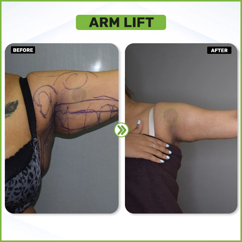 ARM LIFT before and after