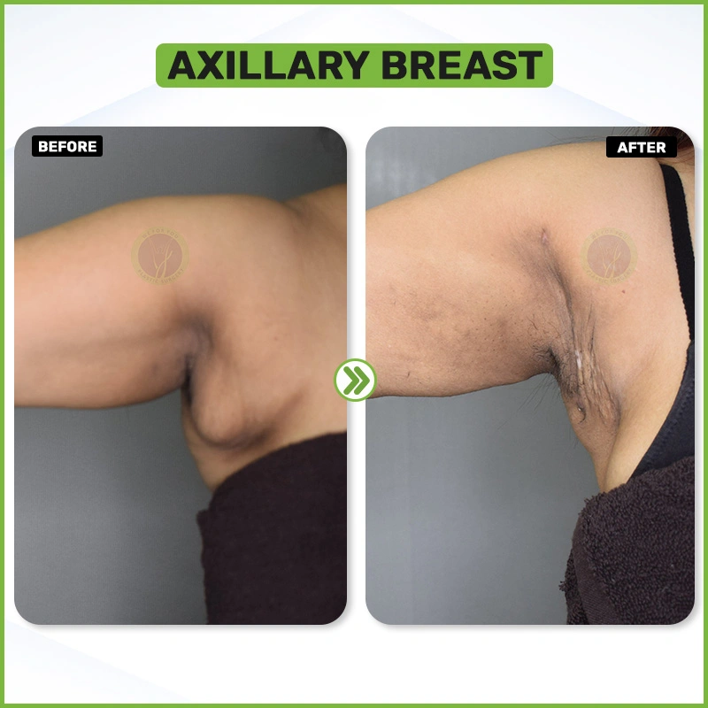 AXILLARY BREAST Before and after 