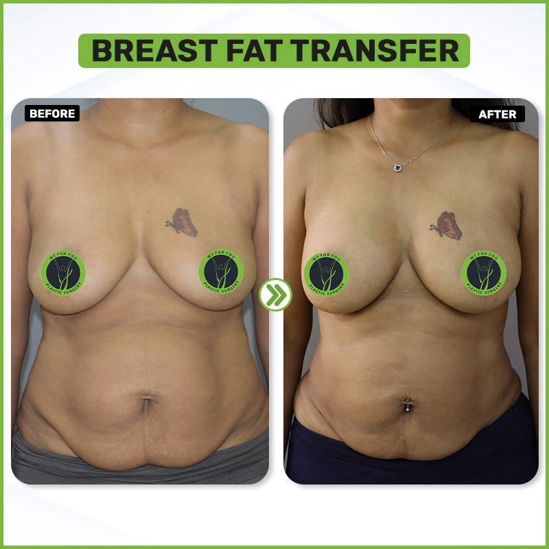 Breast Fat Transfer Before and after