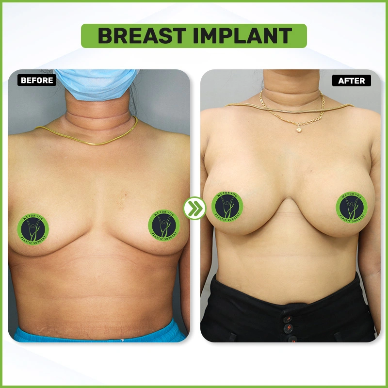 breast implant Before and after
