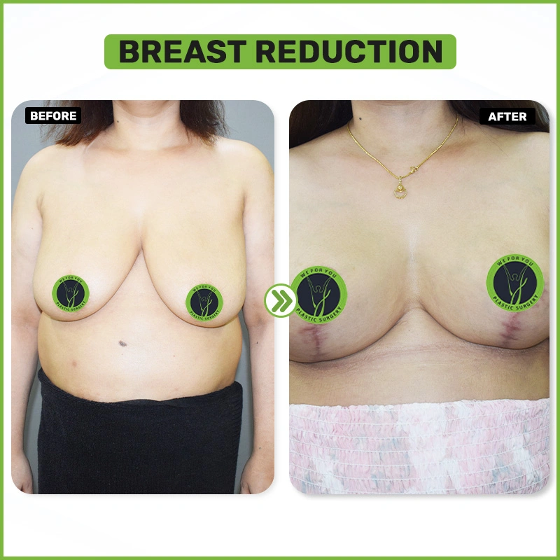 breast Reduction Before and after