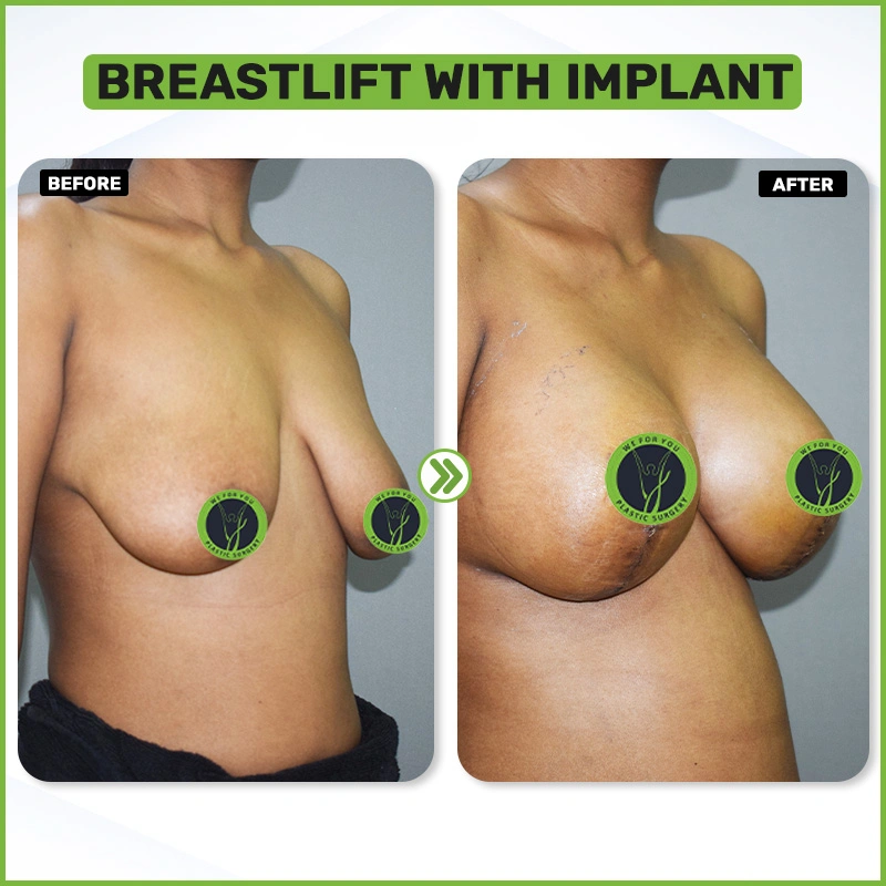 BREASTLIFT WITH IMPLANT