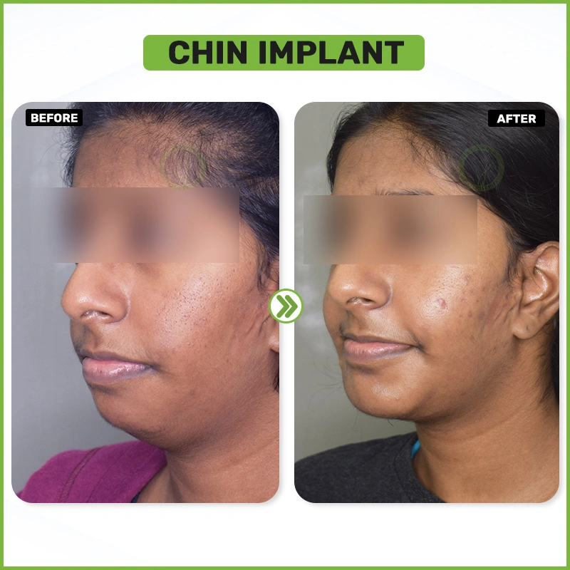 chin implant Before and after