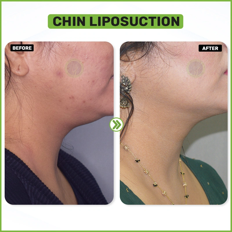 chin liposuction before and after