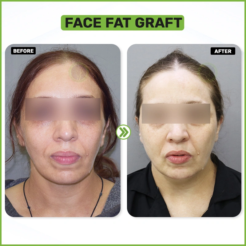 Face Fat Grafting Before and after