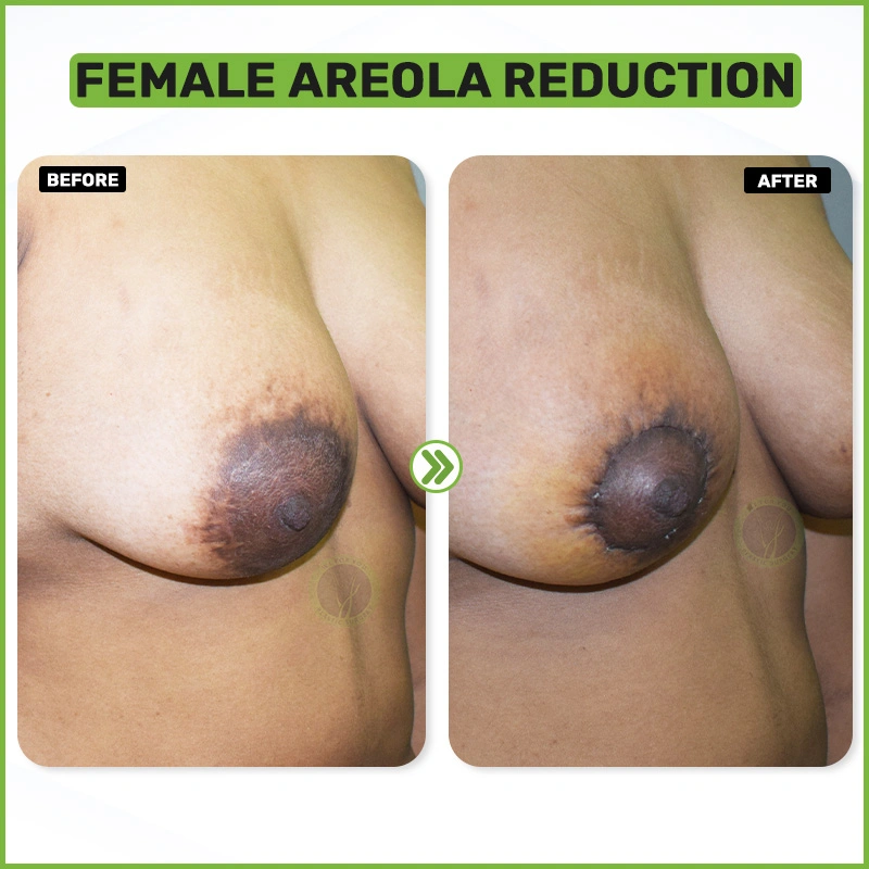 Female areola reduction before and after
