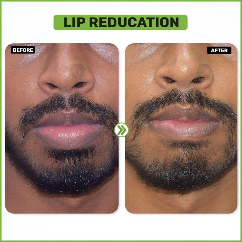 lip reduction Before and after
