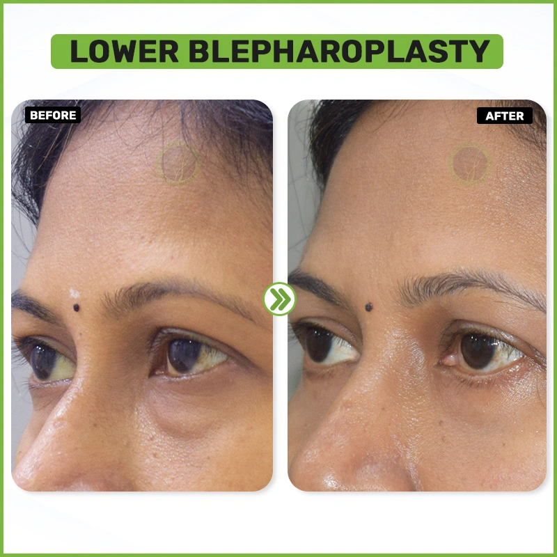 lower blepharoplasty Before and after