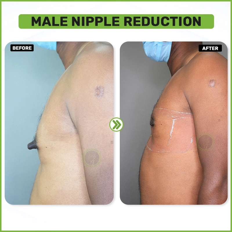 male nipple reduction Before and after